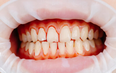 Bleeding Gums: Your Guide to Causes, Prevention and Treatment