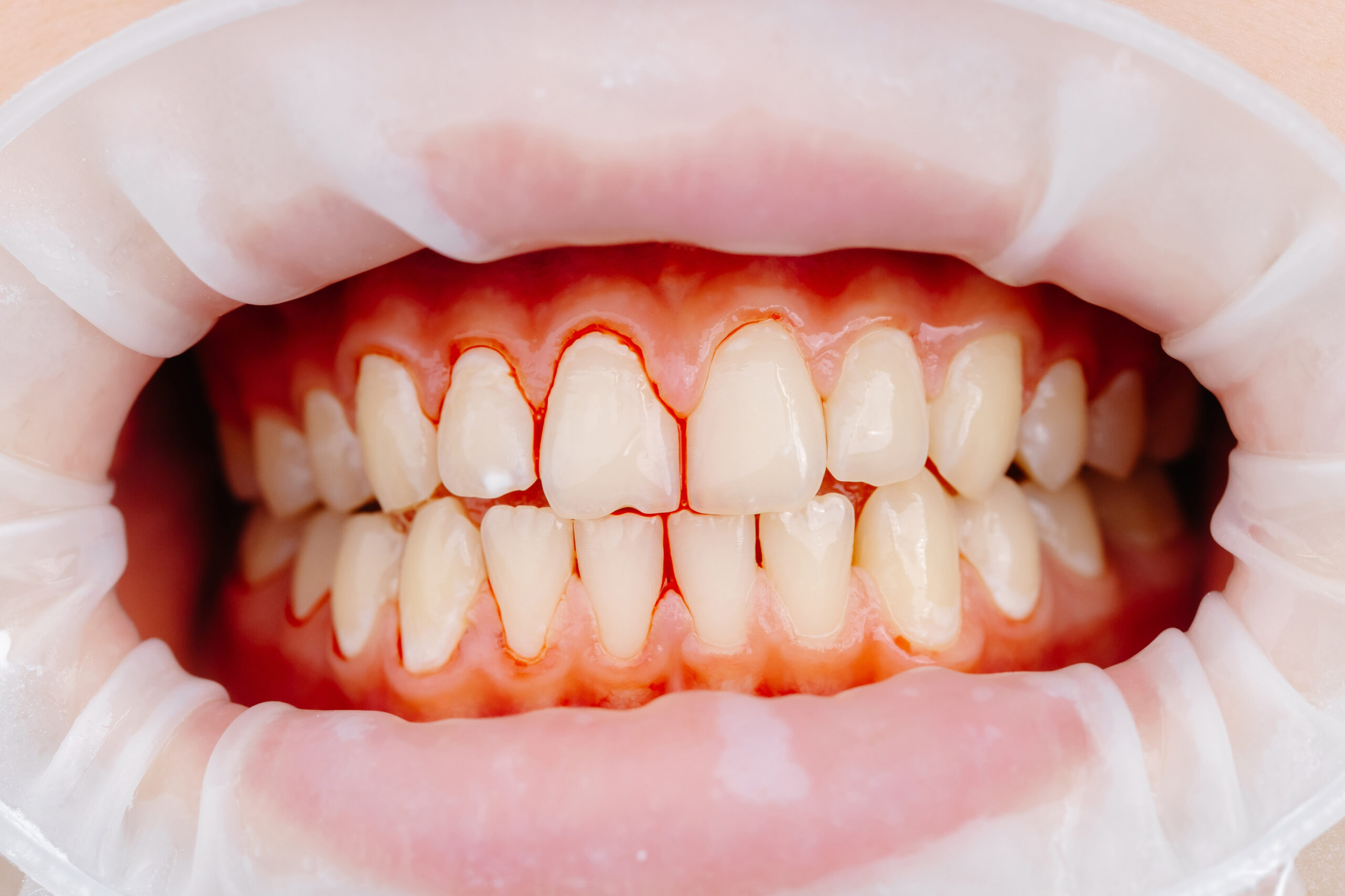 Close-up of inflamed gums bleeding around teeth during a dental exam, showing early signs of gum irritation and gingivitis.