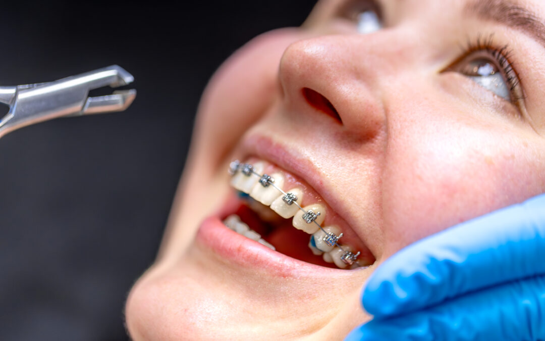 Close-up of patient with braces during an orthodontic adjustment, showing dental care and treatment process