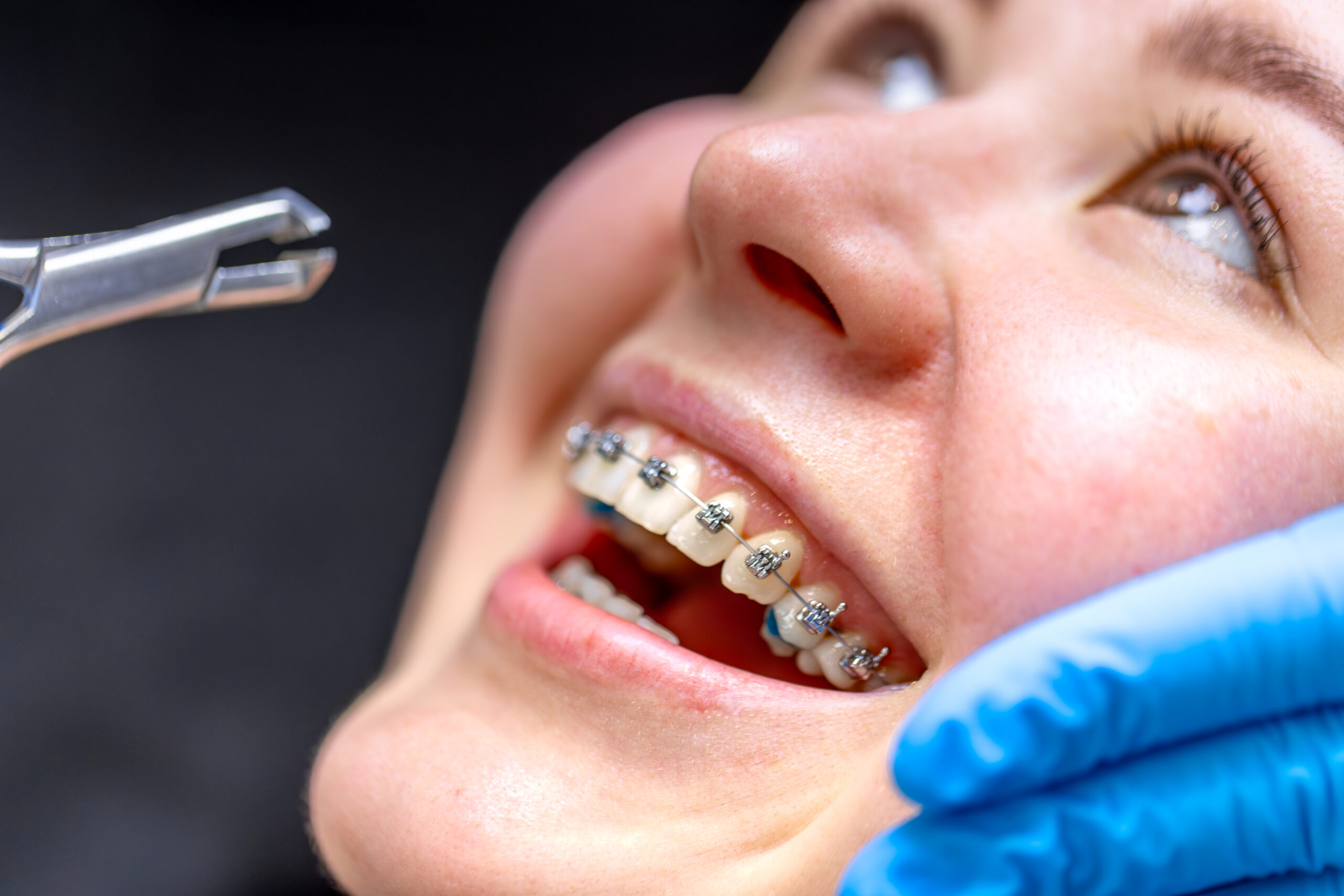Close-up of patient with braces during an orthodontic adjustment, showing dental care and treatment process