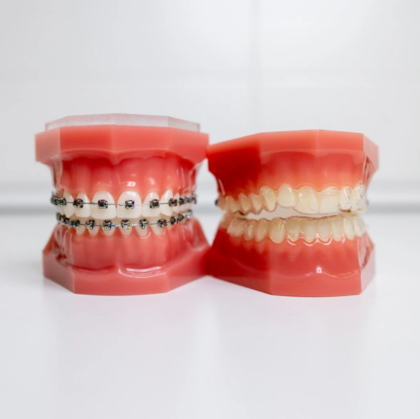 Dental model showing braces for adult orthodontic treatment at Adult & Pediatric Dental Studio