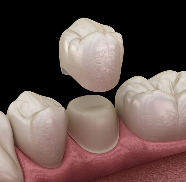 Dental crown models displayed at Adult & Pediatric Dental Studio
