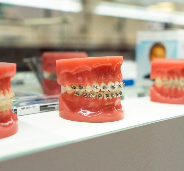 Dental model showing types of braces available at Adult & Pediatric Dental Studio