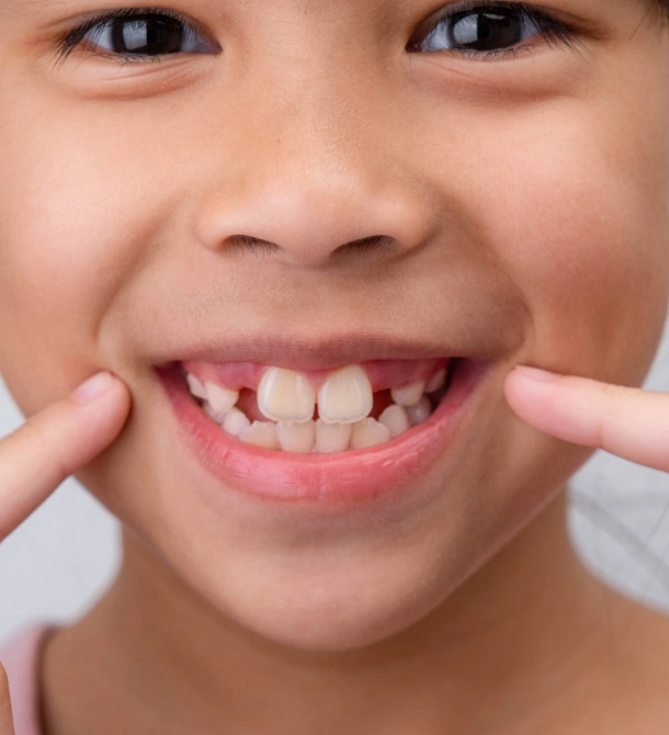 Close-up of a young child smiling and pointing to their teeth for early orthodontic evaluation