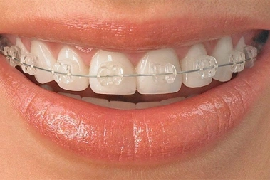 Close-up of teeth with clear ceramic brackets and orthodontic wire