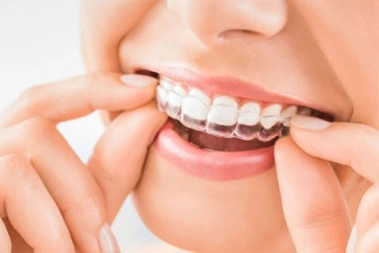 Close-up of a person putting a clear Invisalign aligner onto their teeth