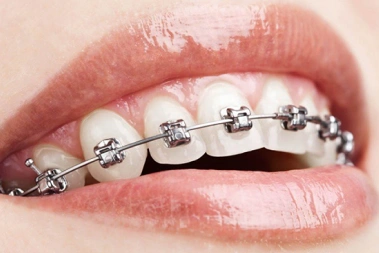 Close-up of a patient's teeth with traditional metal braces