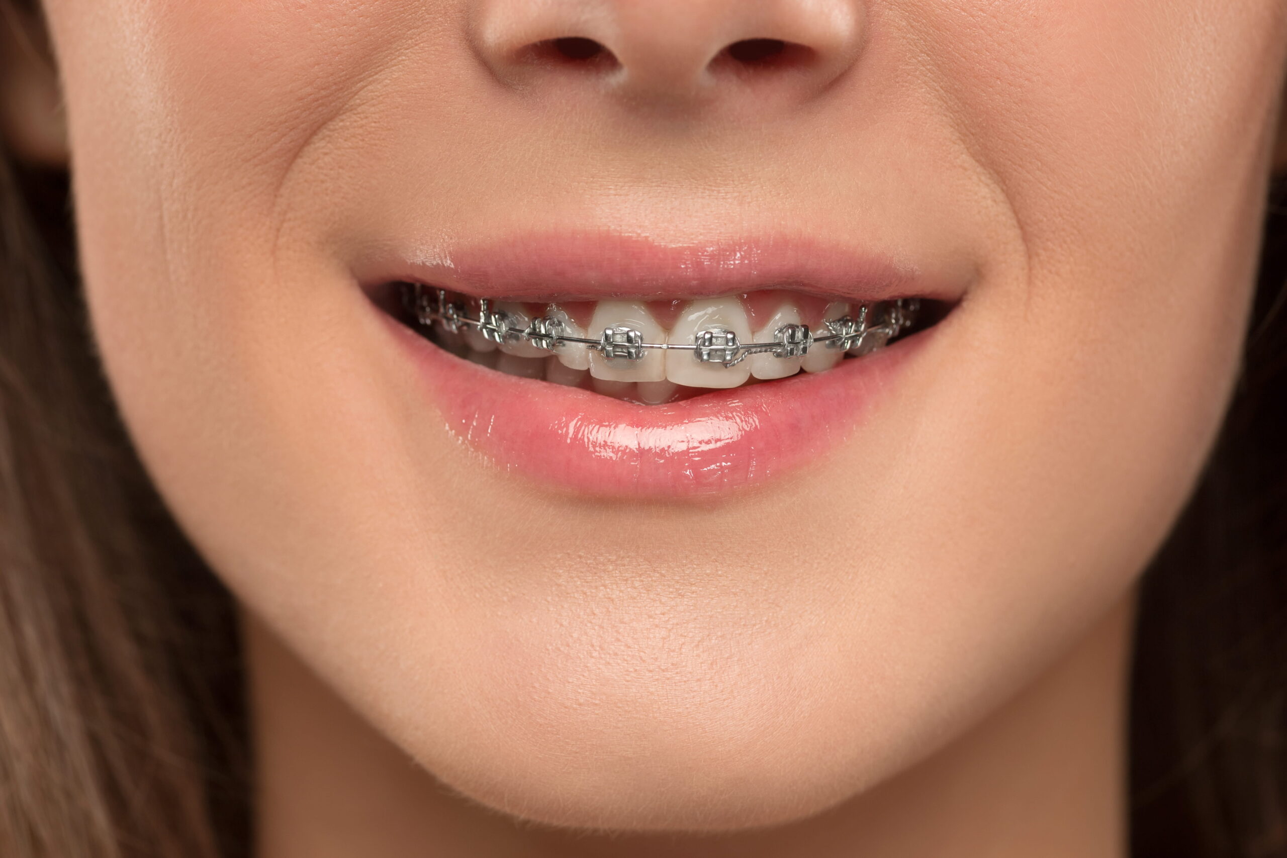Adult Braces in Monroe