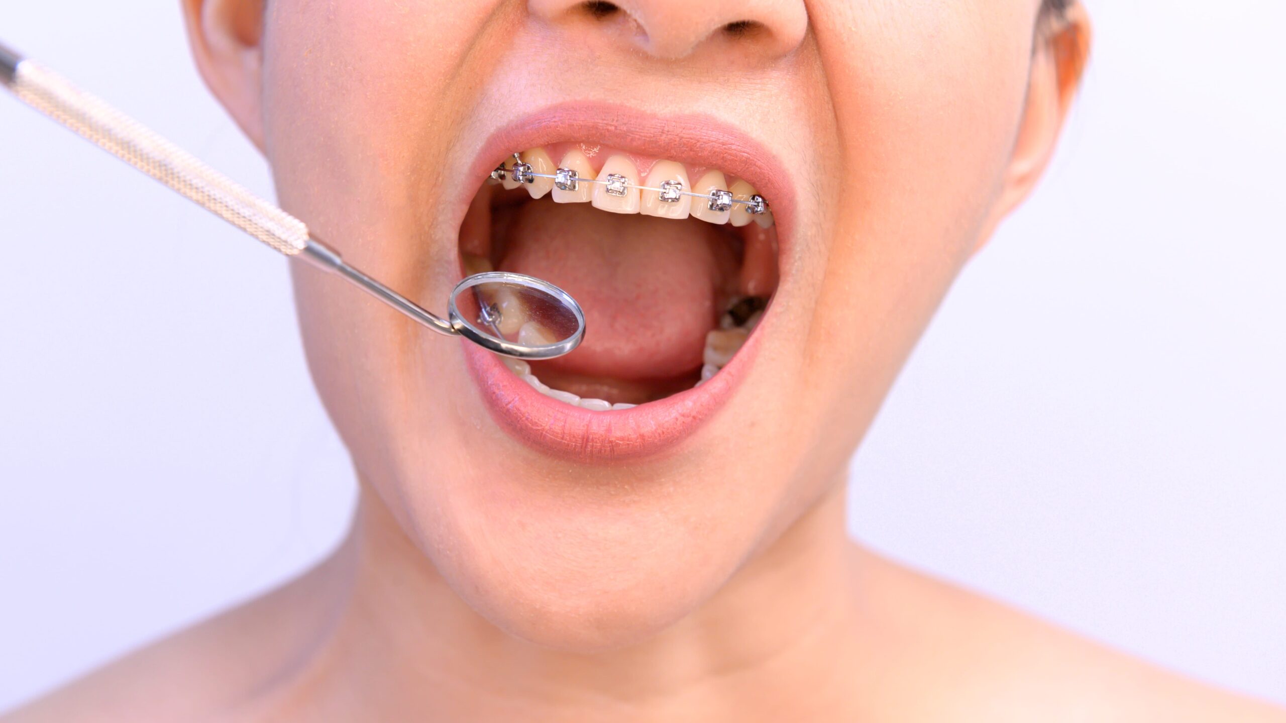 dental braces in Freehold
