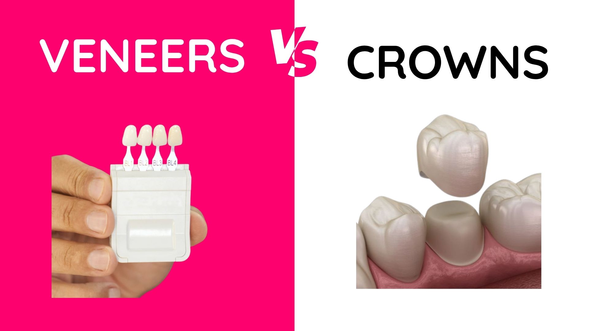 Veneers vs. Crowns