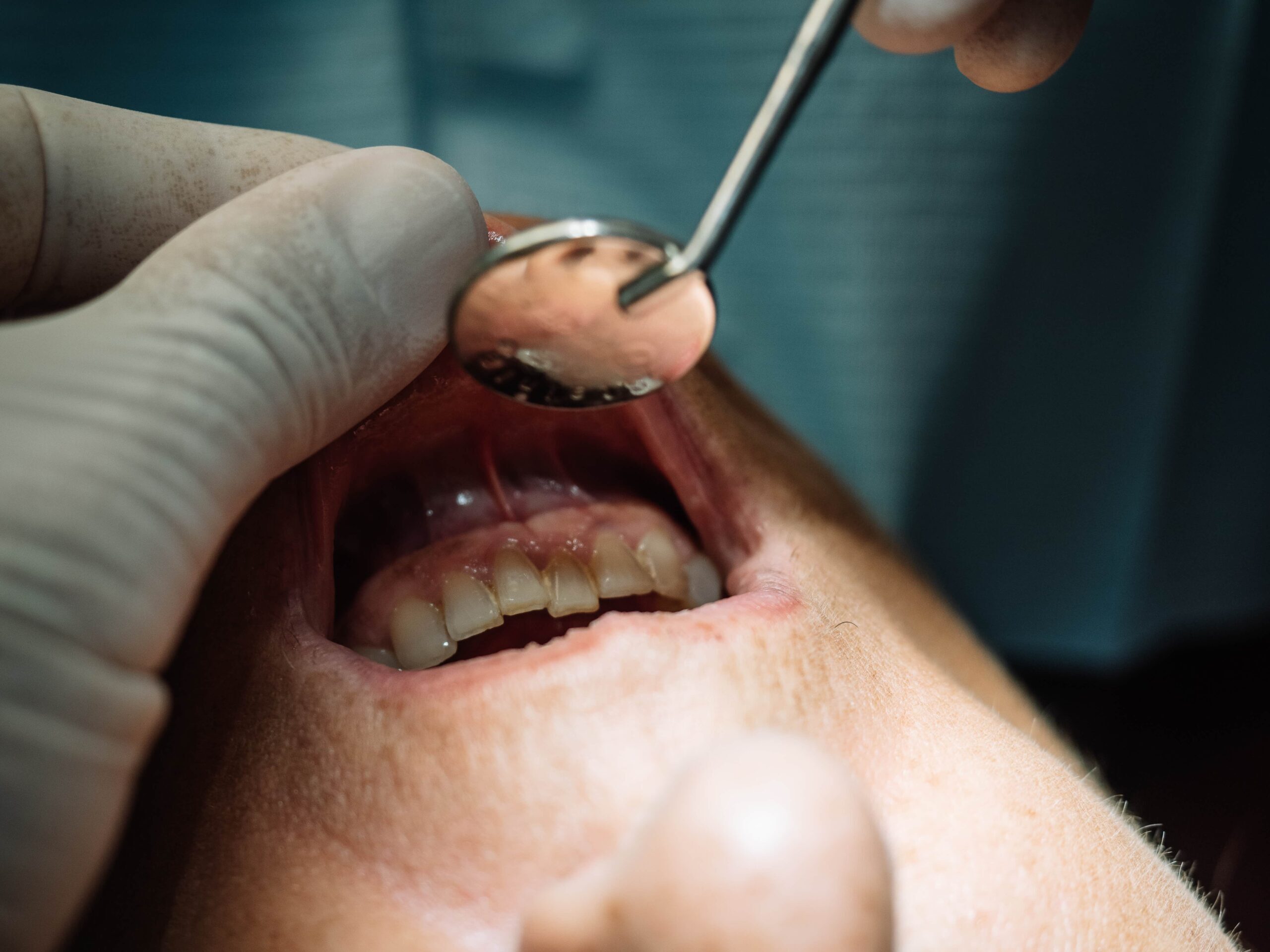 Dentist examining patient's teeth with dental mirror during oral cancer screening procedure.