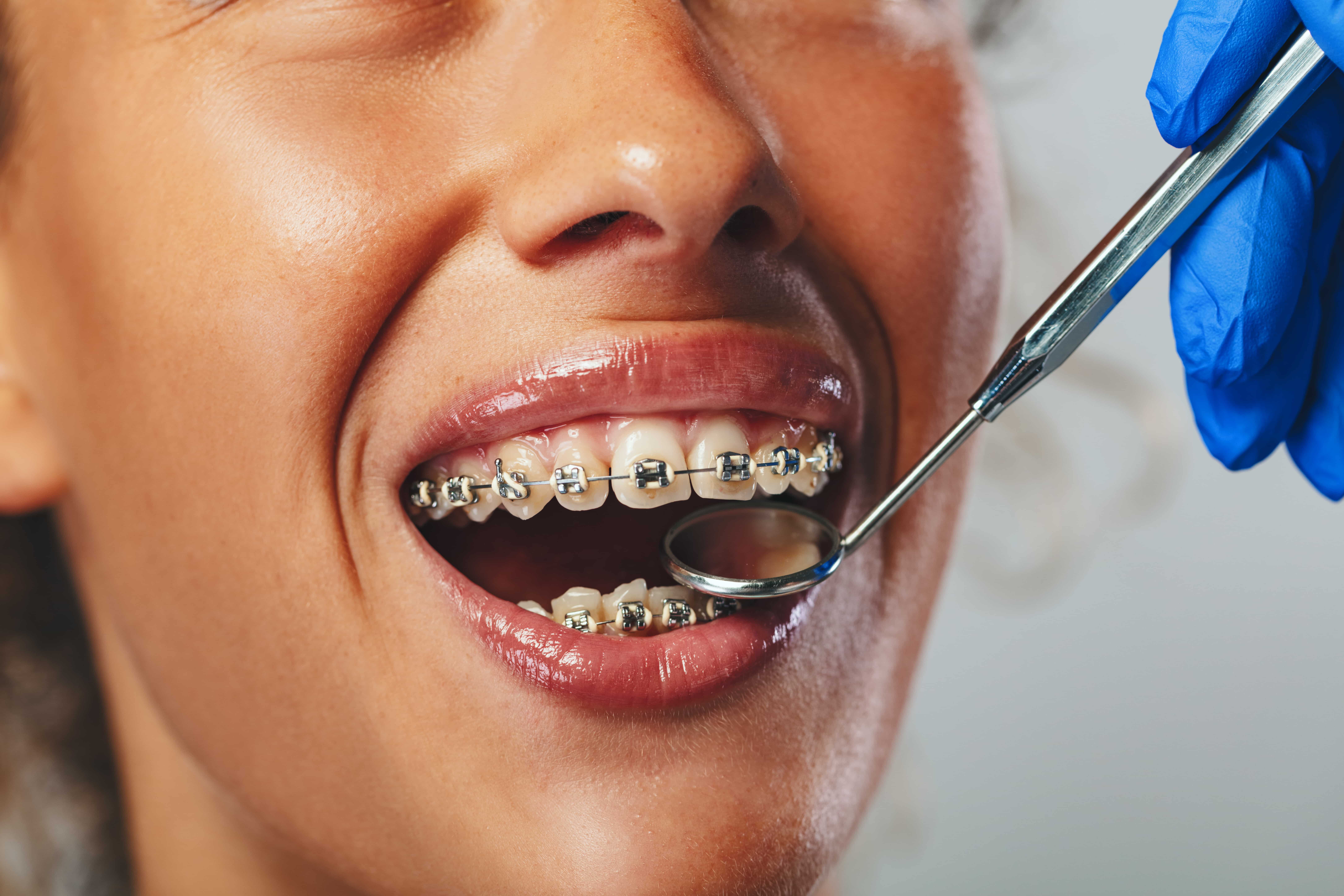 Why Braces Take Longer